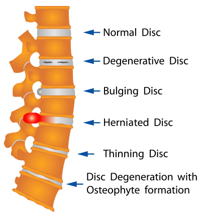 Spine Pain Sources